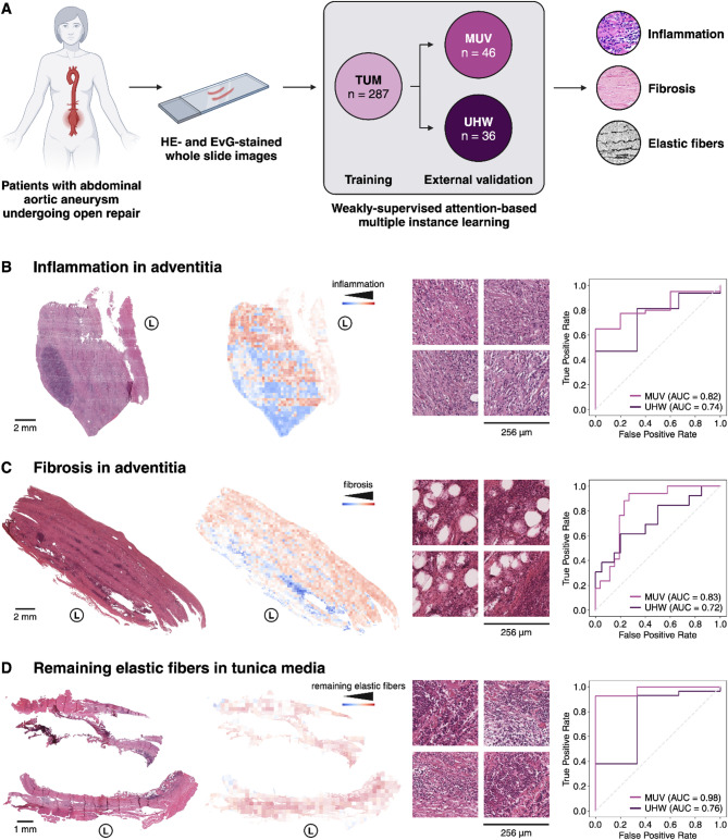 Histopathological evaluation of abdominal aortic aneurysms with deep learning.