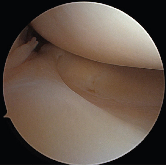 An Anomalous Attachment of the Medial Meniscus Posterior and Anterior Roots Mimicking a Bucket Handle Meniscus Tear: A Case Report and Review of the Literature.
