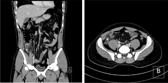 <i>Comamonas testosteroni</i> in perforated appendicitis: a rare cause of intra-abdominal infection.