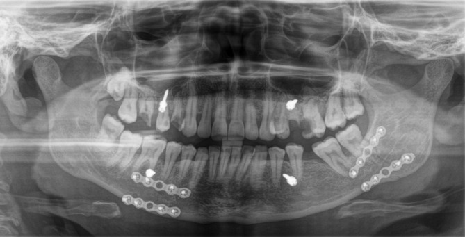 One-plate versus two-plate fixation in the treatment of mandibular angle fractures: a retrospective two-centre comparative study.