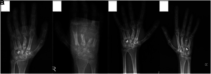 Osteomyelitis with a Pathologic Fracture, Mortal Liver Abscess, and Cholelithiasis: Distinct Features in two Families with the Same p47-phox Mutation.