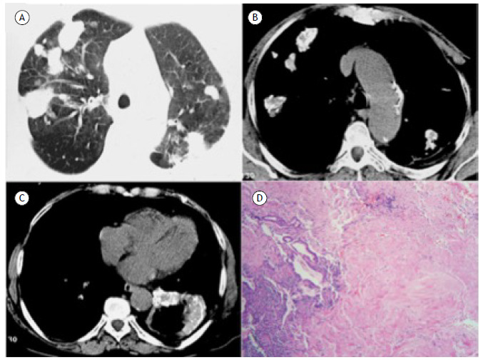 Pulmonary hyalinizing granulomas.