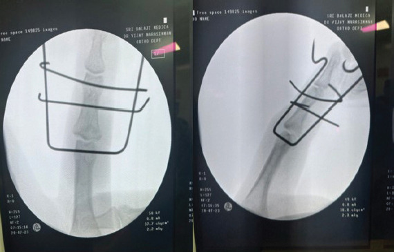 Dynamic External Fixation Using Suzuki Frame for Intra-articular Middle Phalanx Base Fracture with Dorsal Subluxation: A Case Report.