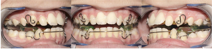 Soft tissue evaluation of functional therapy in growing patients with class II malocclusion: mandibular advancement vs. twin block-a retrospective study.