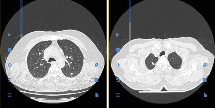 Delayed Pulmonary Metastasis of Basal Cell Carcinoma 10 Years After Primary Excision: A Case Report and Literature Review.