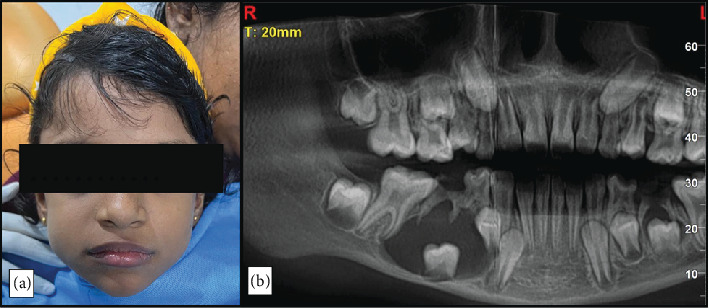 Successful Preservation of a Developing Unerupted Tooth Associated With Dentigerous Cyst in a Child: A Case Report.