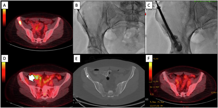 Percutaneous microwave ablation of bone lesions: a retrospective cohort study.