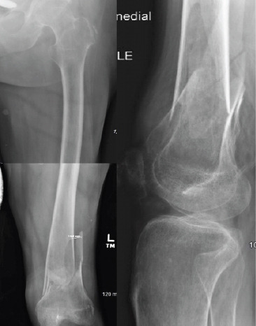 Treatment of Bilateral Distal Femoral Shaft Fractures in a Paraplegic Patient with Intramedullary Nailing: A Case Report.