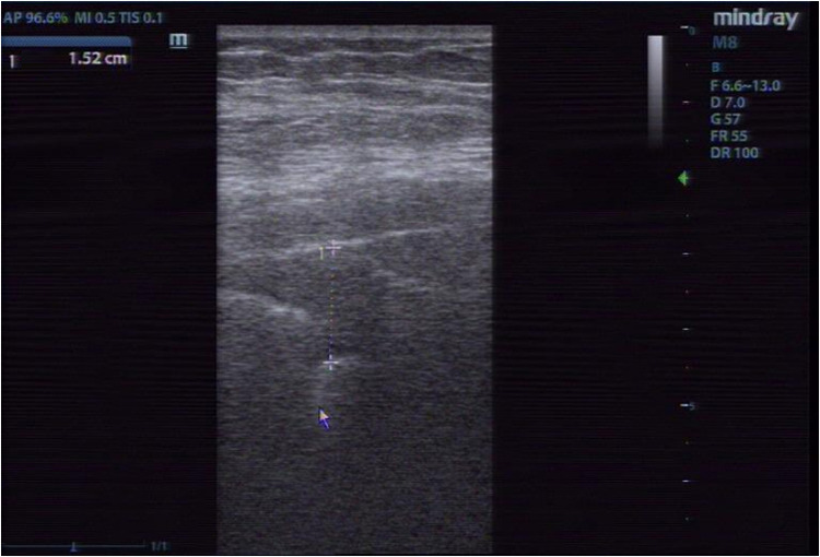 Diagnostic Value of Bedside Lung Ultrasound and Chest CT on Subpleural Lesions and Lung Consolidation in ICU Patients with Severe Pneumonia.