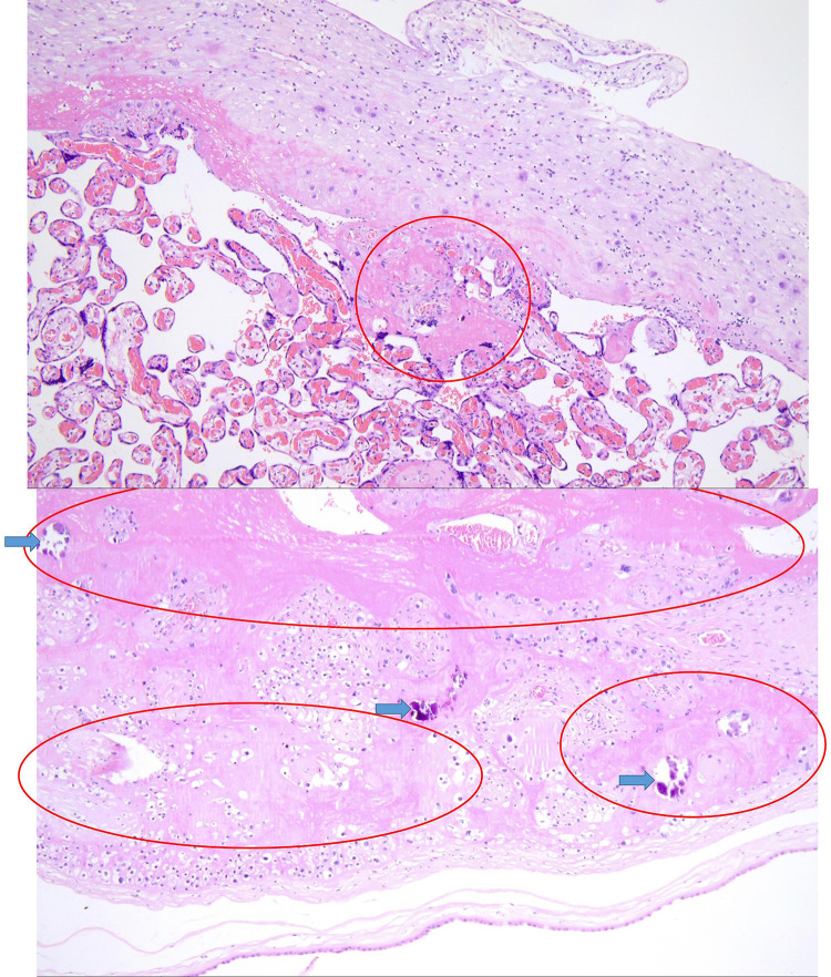 Coexistence of Congenital Dysfibrinogenemia and Antiphospholipid Syndrome in Pregnancy: A Case Report.