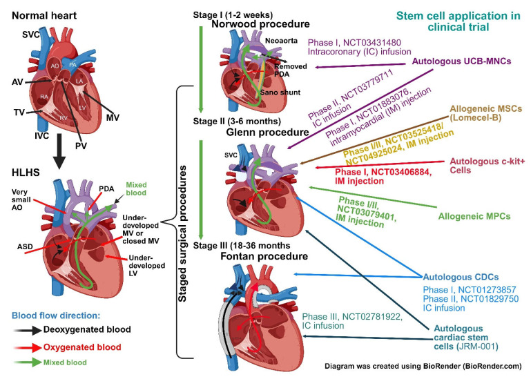 Updated Applications of Stem Cells in Hypoplastic Left Heart Syndrome.