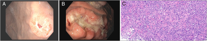 When Cancer Erupts: Recognizing the Volcano Lesion in Gastric Metastases.