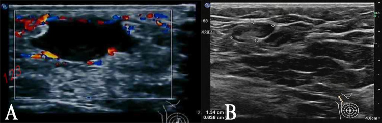 Surgical Management of Recurrent Plasma Cell Mastitis in a Male Patient: A Case Report.