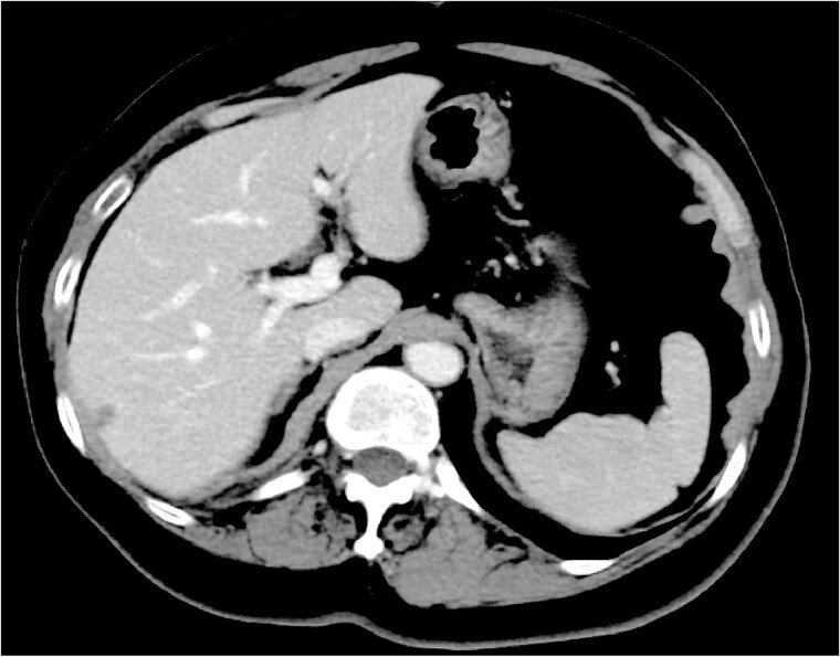 Isolated splenic metastasis presenting at diagnosis of HER2-positive <i>de novo</i> metastatic breast cancer: a case report.
