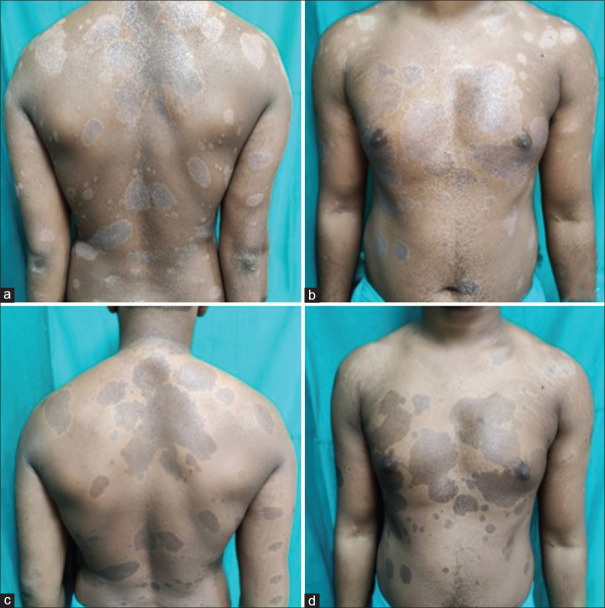 Successful Treatment of Psoriasis in HIV with Secukinumab.