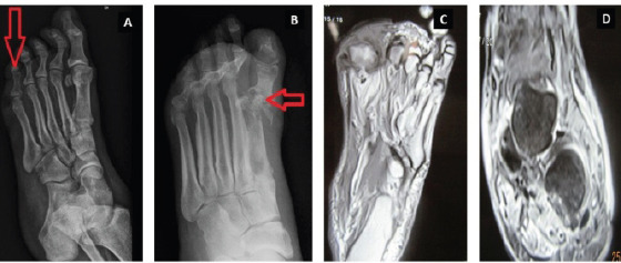 Role of Biomarkers in Diabetic Foot Osteomyelitis.
