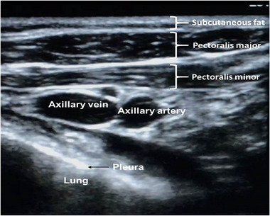 Ultrasound Guided Venous Access for Cardiac Devices: Defining Learning Curve for Safety, Efficacy, and Radiation Exposure.