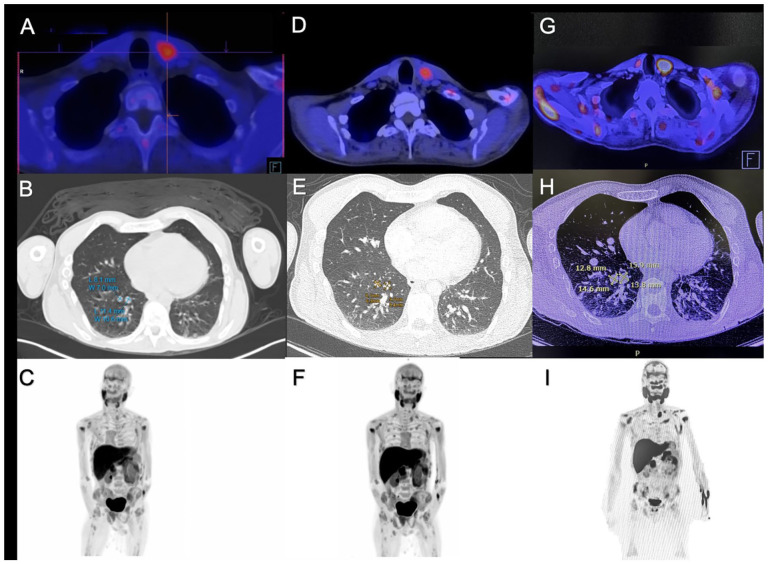 Biochemical and Structural Response to Lenvatinib in Metastatic Parathyroid Carcinoma: Case Report.
