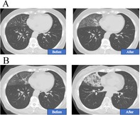 The Paradox of Metachronous Lipoid Pneumonia.