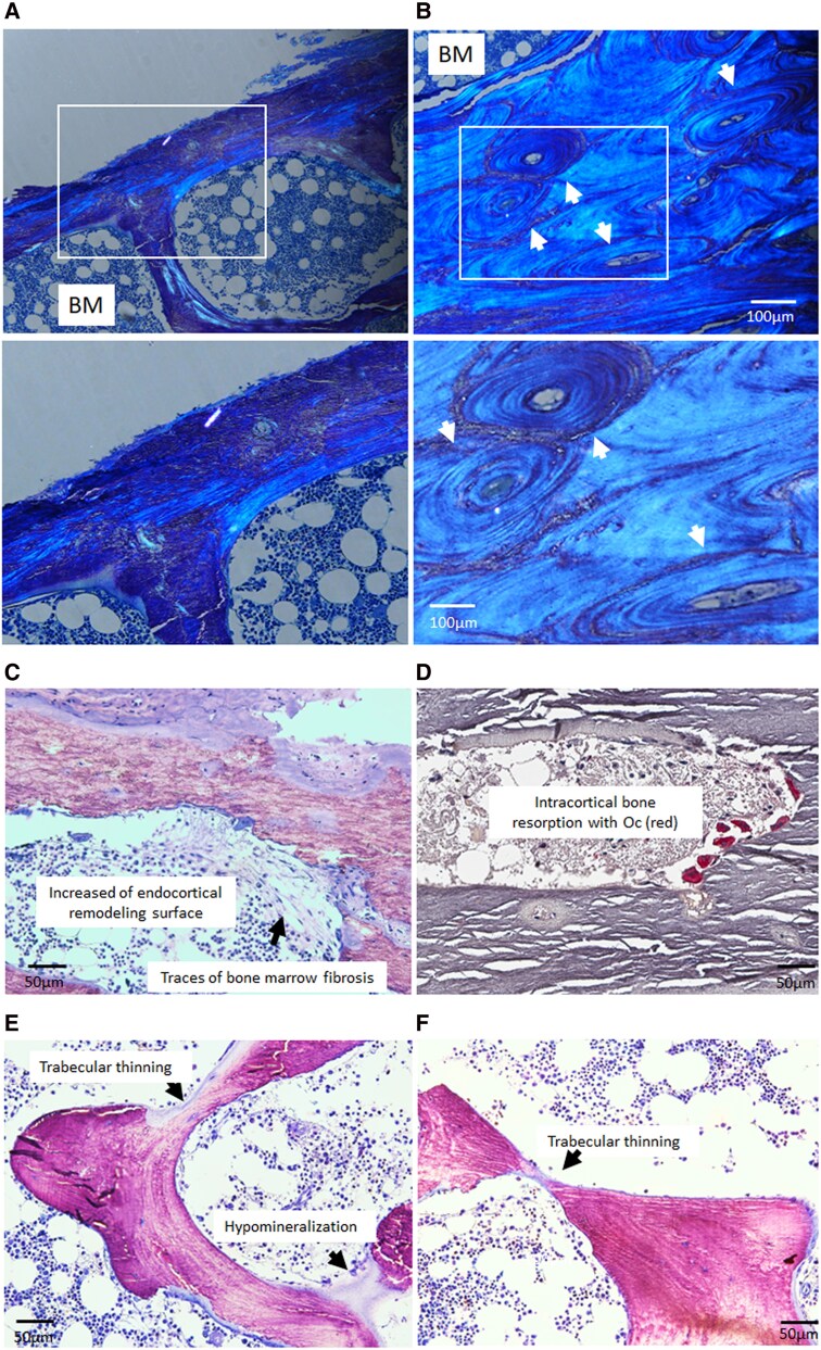 Jansen's Disease: Bone Abnormalities Beyond Chondrodysplasia.