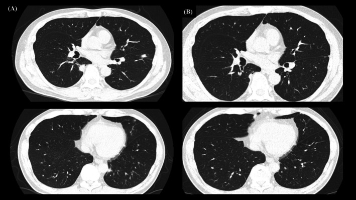 Asymptomatic Neurosyphilis Presenting With Bilateral Pulmonary Nodules: A Case Report.