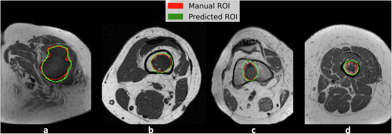 Deep learning for automated segmentation of central cartilage tumors on MRI.