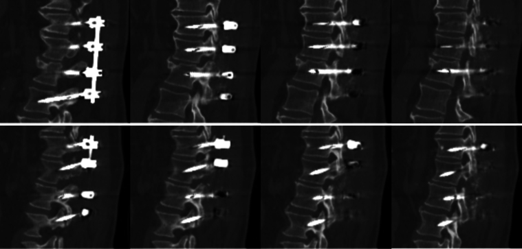 Metal artifact reduction leading to appearance of fractures in pedicle screws: illustrative case.