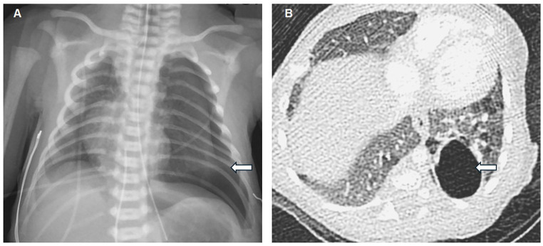 Pneumatoceles or Not? Case Reports on Pulmonary Cystic Lesions in Infants.