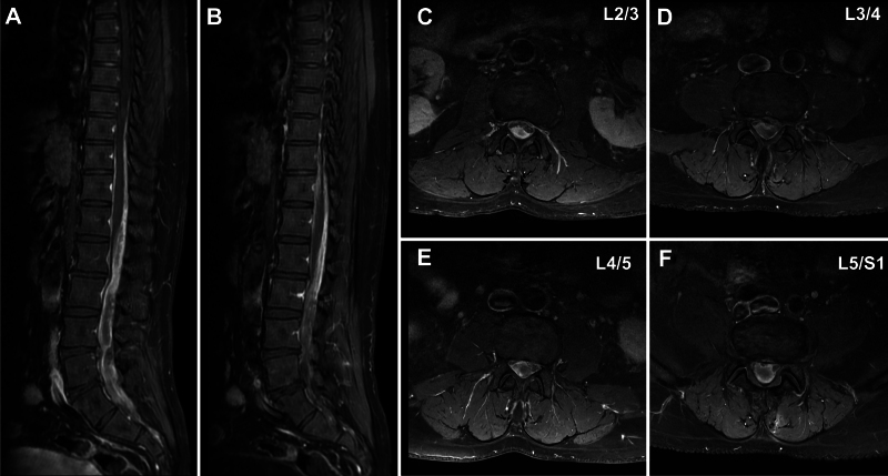 Subdural and epi-arachnoid hemorrhage following spinal epidural block requiring hematoma removal: illustrative case.