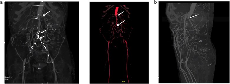 Lerich syndrome revealed by renal failure: a case report.