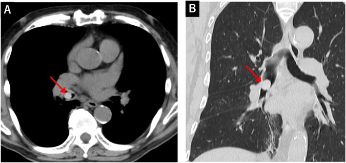 A Case of Bronchial Foreign Body Aspiration Caused by Inhaling a Mukago (Edible Yam Bulbil) Presenting With Persistent Cough.