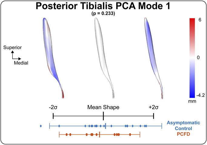 An All-Female Study Quantifying Morphological Differences of the Hindfoot and Posterior Tibialis Muscle Between Patients with Progressive Collapsing Foot Deformity and Asymptomatic Controls.