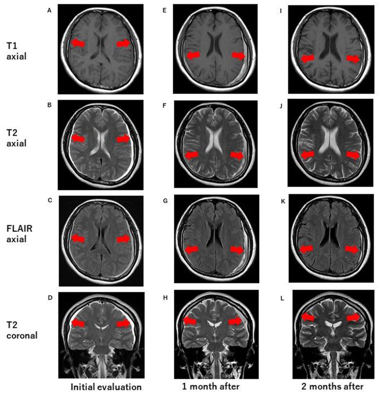 Bilateral Subdural Hematoma Caused by Cervical Traction.
