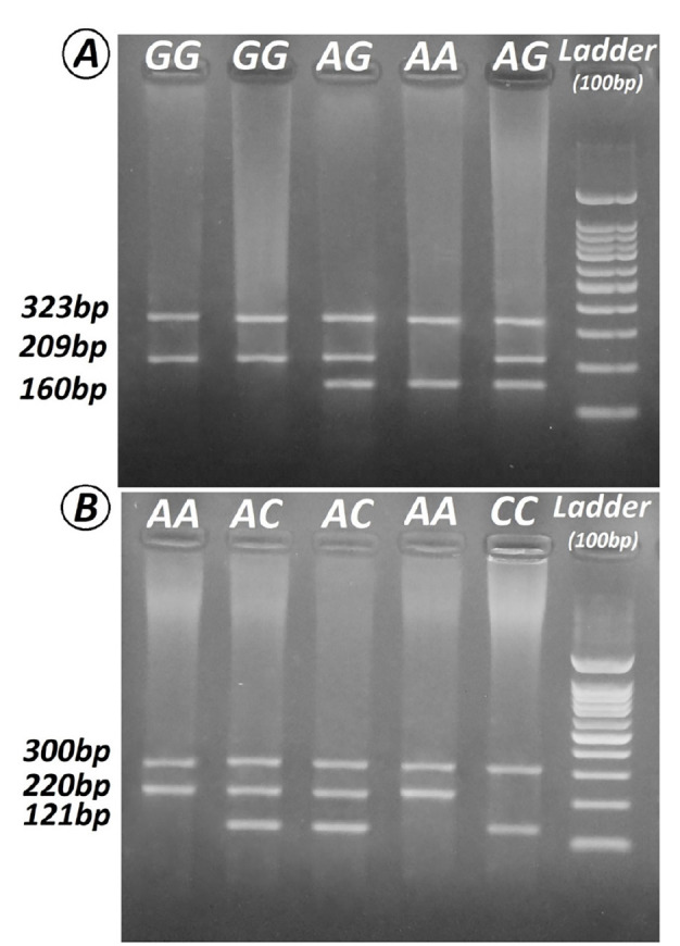 The Role of Functional Polymorphisms of Apoptotic <i>BAX</i> (-248G>A) and Anti-Apoptotic <i>BCL2</i> (-938C>A) Genes in the Development of Vitiligo: A Cross-sectional Study.