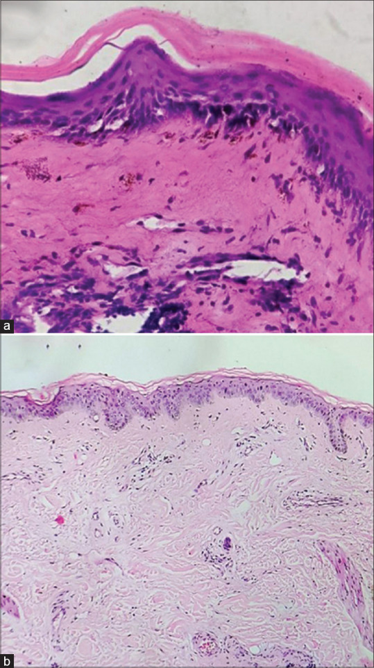Parry-Romberg Syndrome with Localized Plaque Morphea and Localized Discoid Lupus Erythematosus: A Case Report of a Rare Overlap.
