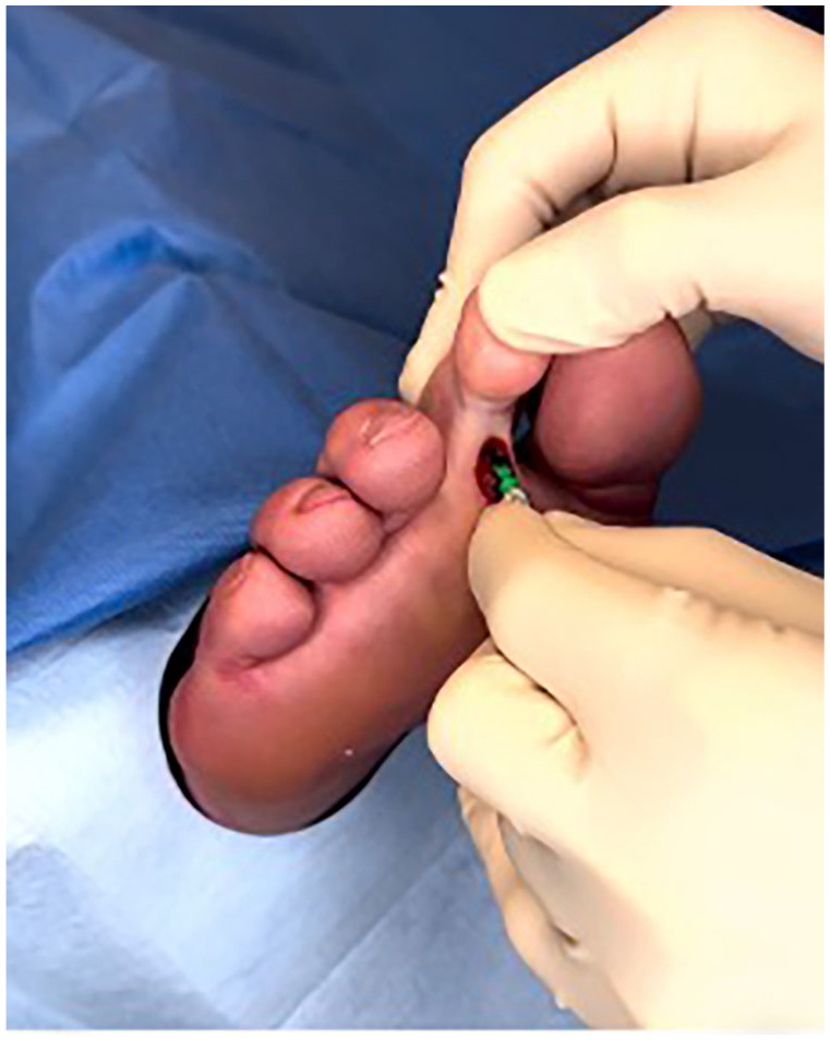 Minimally Invasive Plantar Capsule Release and Flexor Tenotomy for Rigid Diabetic Hammer Toe: A Technique Tip.