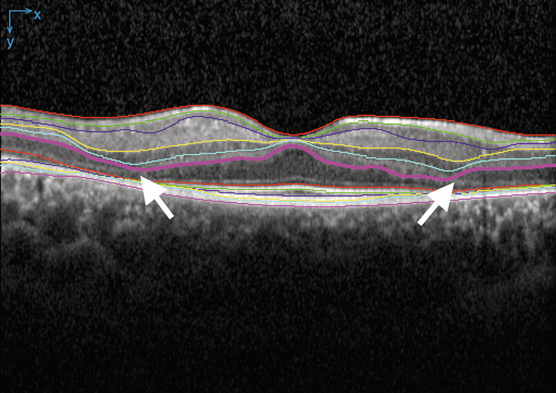 Deep Learning-Based Retinal Layer Segmentation in Optical Coherence Tomography Scans of Patients with Inherited Retinal Diseases.