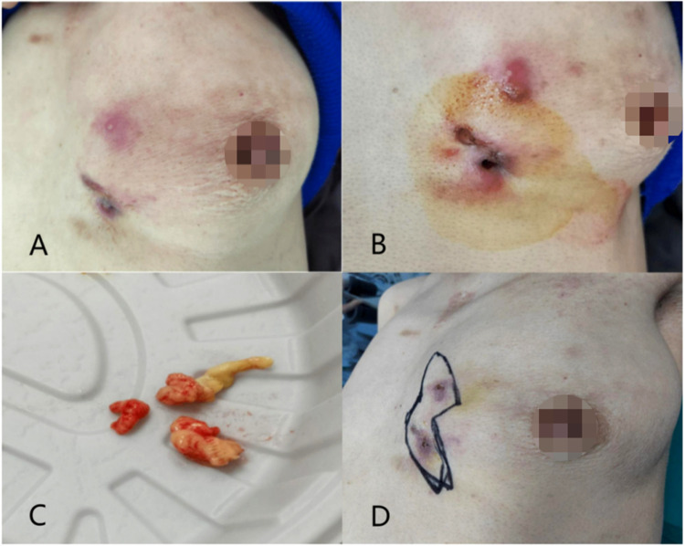 Integrative Medicine Treatment Strategy for Tuberculosis of the Breast Combined with Granulomatous Mastitis: A Case Report.