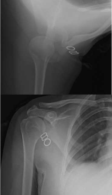 Atypical Idiopathic Inferior Functional Shoulder Instability in a 15-year-old Female: A Case Report and Review of Literature.