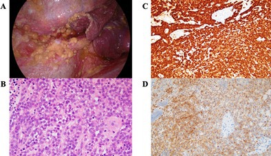 Radiotherapy-Induced Pleural Mesothelioma in a Childhood Leukaemia Survivor: A Case Report.