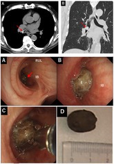 A Case of Bronchial Foreign Body Aspiration Caused by Inhaling a Mukago (Edible Yam Bulbil) Presenting With Persistent Cough.