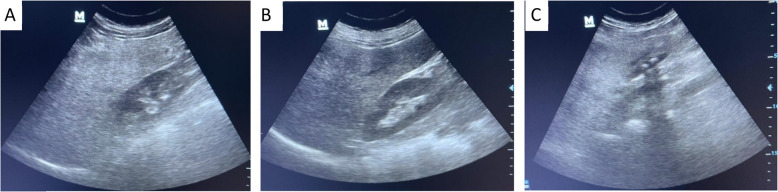 Screening for metabolic-associated fatty liver disease in type 2 diabetes patients using non-invasive scores and ultrasound: a cross-sectional study in Egypt.