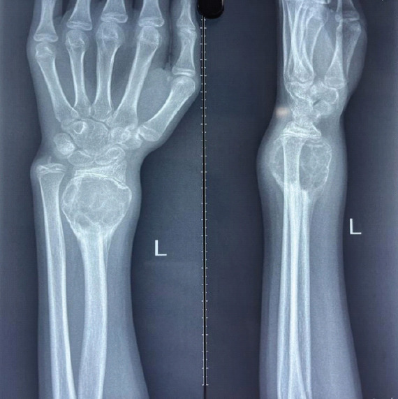 A Novel, Joint Sparing Surgical Approach to the Management of Giant Cell Tumor of the Distal Radius in a Pediatric Patient: A Case Report and Comprehensive Literature Review.