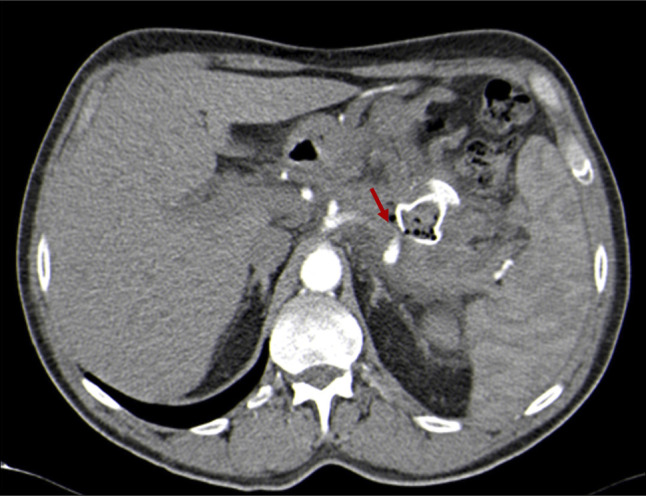 Lumen-Apposing Metal Stent Bleeding Risk: Management of Splenic Artery Erosion.