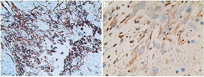 Metastatic epithelioid sarcoma on the arm: presentation of a case report.
