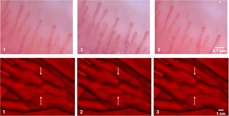 Enhancing the quantification of post-occlusive reactive hyperemia: a multimodal optical approach.