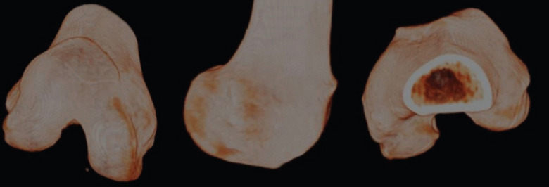Chronic Flexion Patellar Dislocation with Femoral Patellofemoral Dysplasia and Anterior Bump: Treated by Distal Femoral Subtraction Osteotomy and Medial Patellofemoral Ligament Reconstruction - A Case Report.