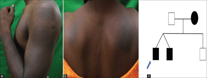 Familial Primary Cutaneous Amyloidosis Across Generations.