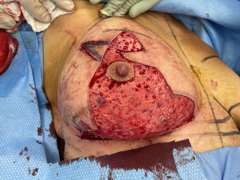 Excess Horizontal Breast Skin Facilitates a Simpler Wise Pattern Split Reduction Incision for Superficial Cancers.