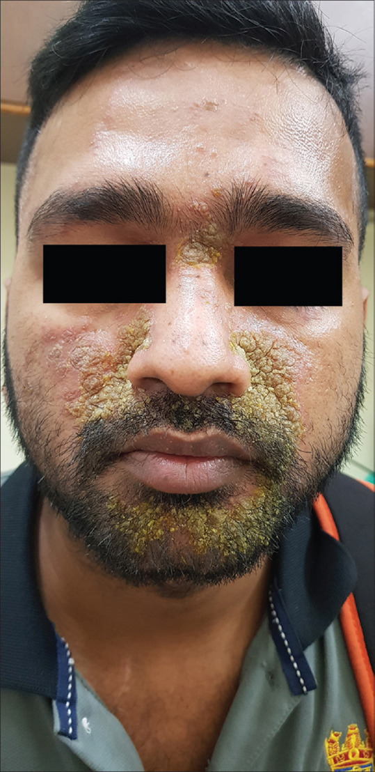 Seborrhoea Herpeticum: A distinct entity or mere coincidence.
